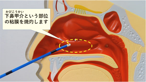 花粉 症 手術